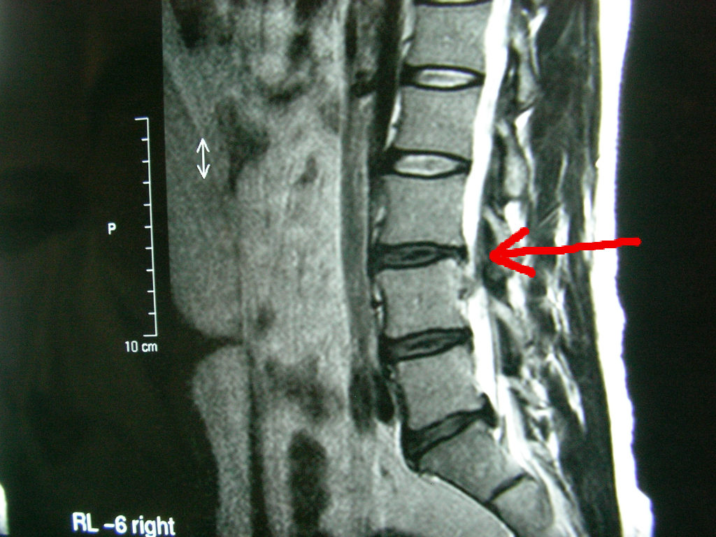 腰椎MRI写真